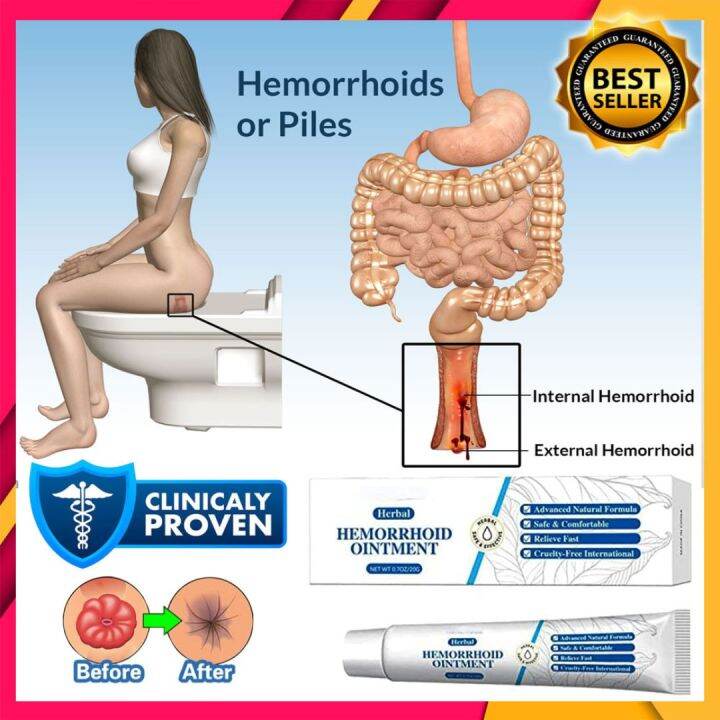 Herbal Hemorrhoid Ointment Cream Relieve Hemorrhoid Pain External Anal