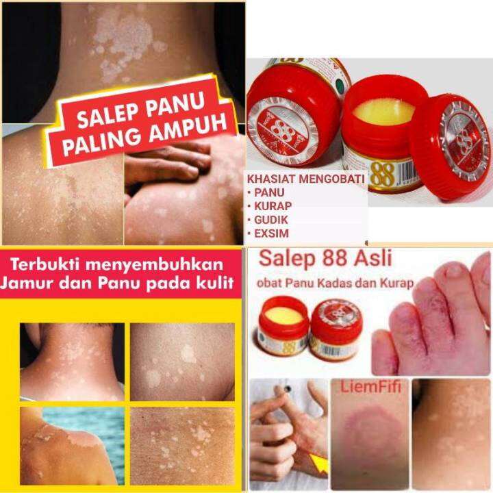 Salep Panu Ampuh Salep Original Salep Kulit Mengatasi Penyakit