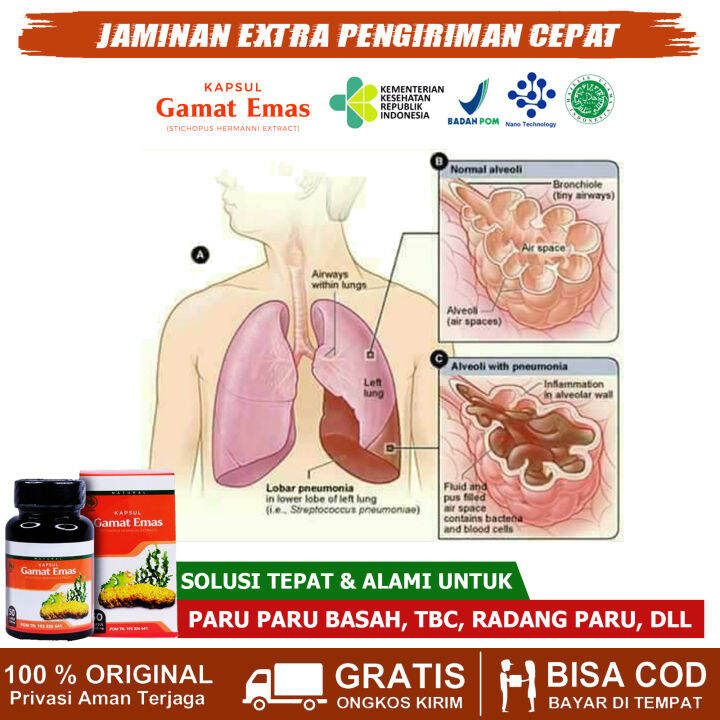 Obat Cairan Paru Paru Basah Infeksi Paru Paru Radang Paru2 Tb Paru