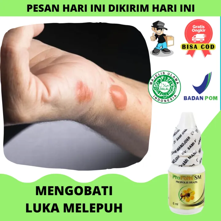 Obat Oles Luka Bakar Luka Terkena Knalpot Air Panas Minyak Panas