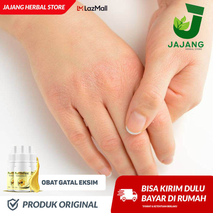 Propolis Asli Obat Gatal Exim Kering Menahun Gatel Eksim Paling Alami