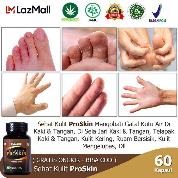 Obat Kutu Air Pada Kaki Infeksi Jamur Gatal Di Sela Jari Kaki Tangan