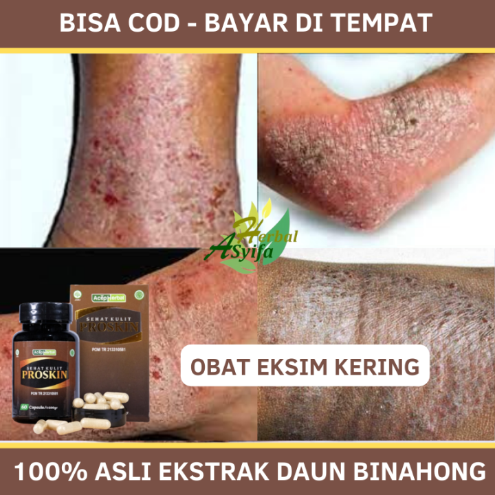 Kapsul Eksim Kering Eksim Di Kaki Tangan Gatal Eksim Menahun Kulit