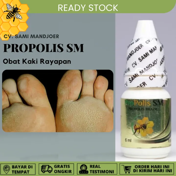 Obat Kaki Rayapan Telapak Kaki Bolong Bolong Dan Bau Kutu Air