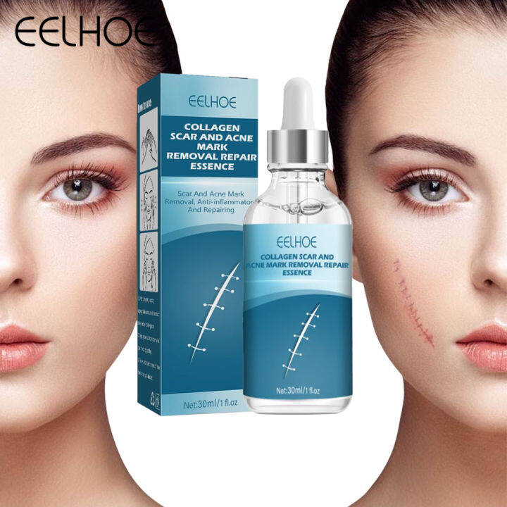 Eelhoe Collagen Acne Mark Scar Repair Essence Stretch Marks Acne Spot