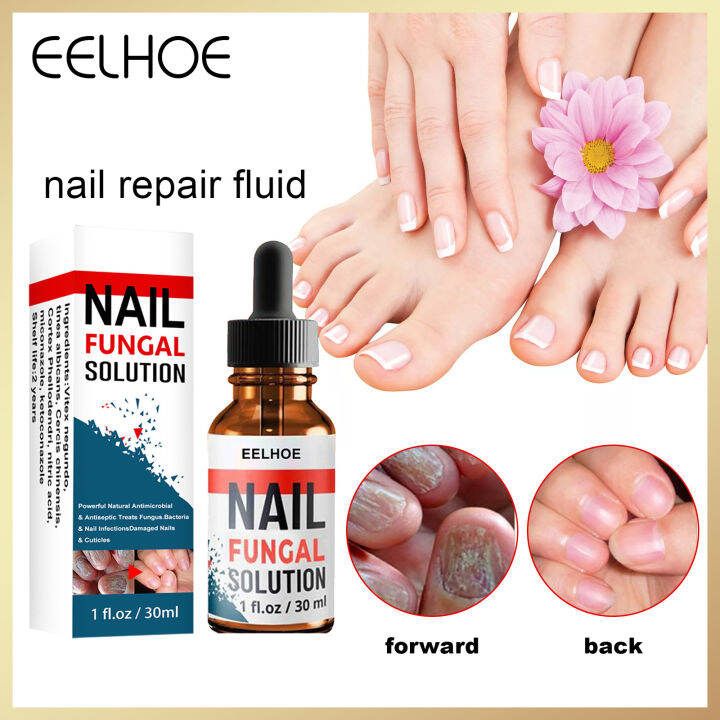 Eelhoe Nail Fungal Solution Foot Nail Fungus Removal Gel Anti Infective