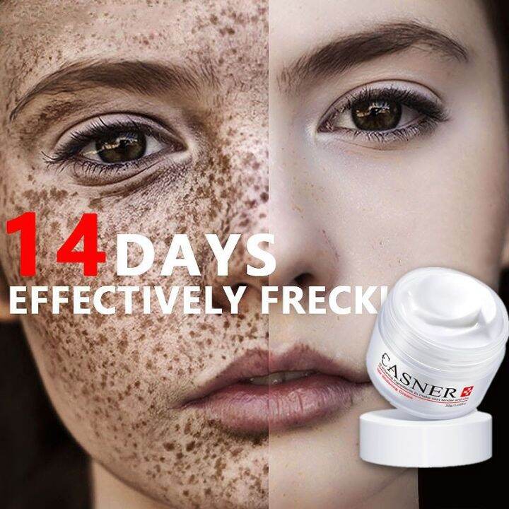 Melasma Removal Cream Original Whitening Freckle Dark Spot Remover