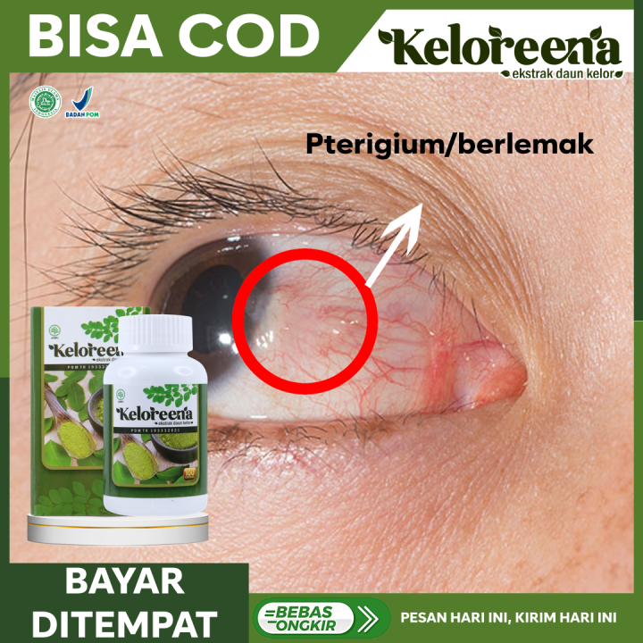 Obat Mata Berlemak Kekuningan Obat Pterygium Obat Pembersih Selaput