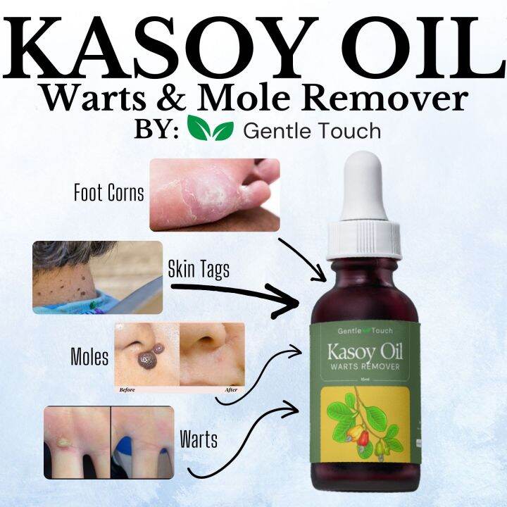 Pure Organic Kasoy Oil For Warts Skintags Moles Removal By Gentle Touch