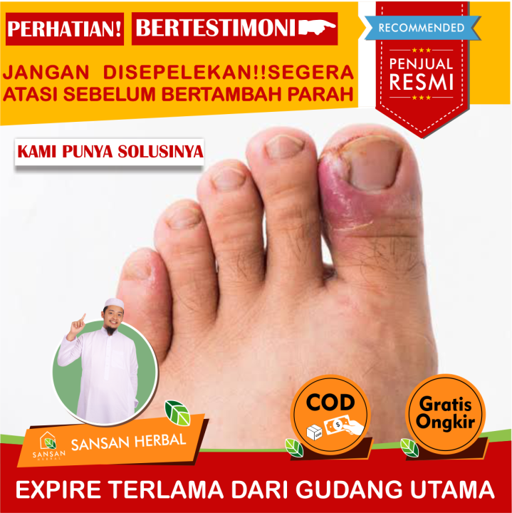 Obat Cantengan Di Kaki Obat Cantengan Obat Cantengan Obat