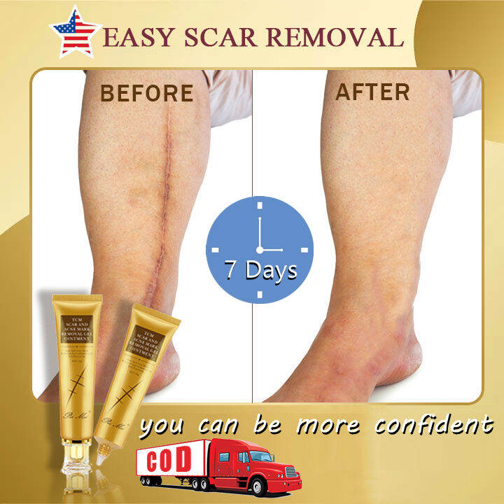 Scar Remover Scar Removal Cream Remove Peklat Remover Bio Oil Stretch