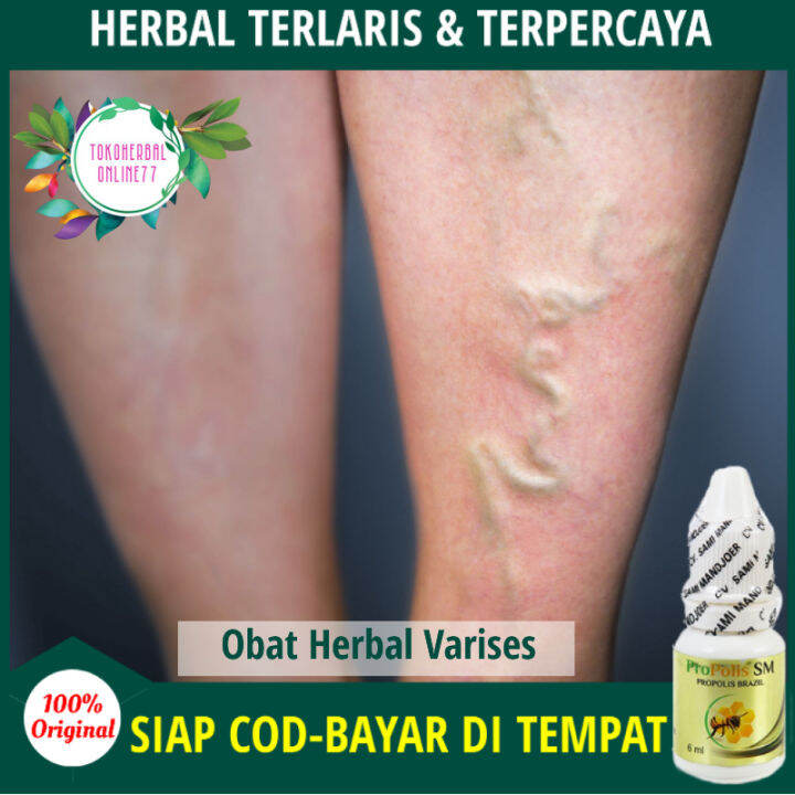 Obat Varises Di Betis Kaki Penghilang Varises Tangan Urat Biru