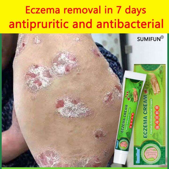 Sumifun Eczema Treatment Cream G Psoriasis Treatment Cream Anti