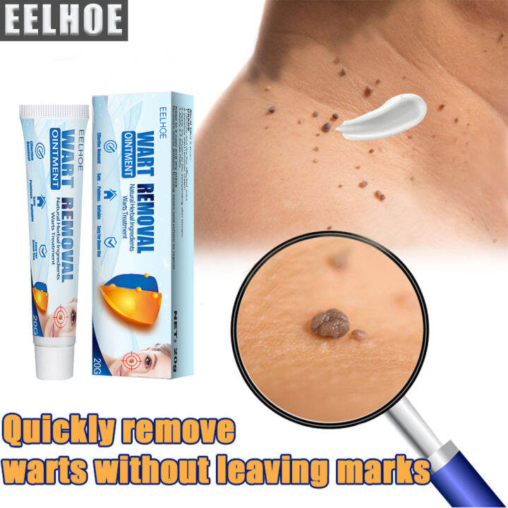 Local Delivery Eelhoewarts Remover Original Cream Warts And Skin Tags