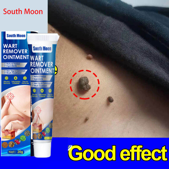 South Moon Warts Remover Original Cream Painless Wart Remover Ointment