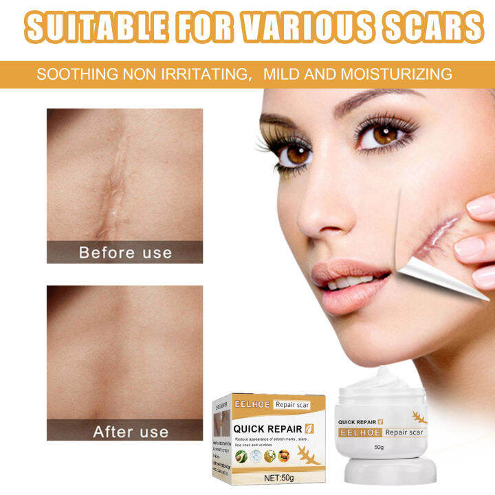 Effectiveeelhoe Old Scar Remover For Legs G Remover Acne