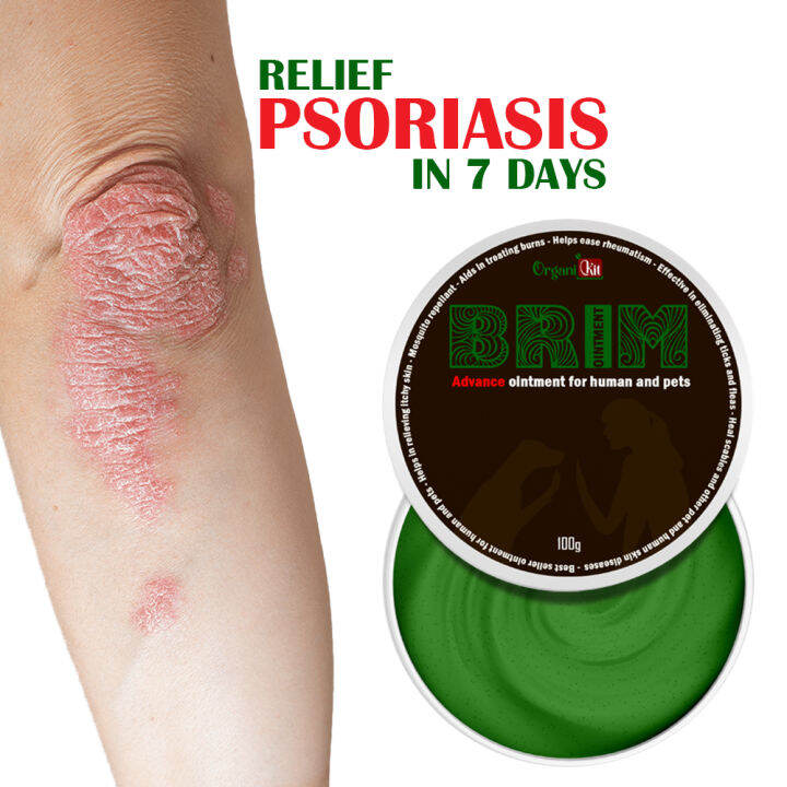 Legit And Effective Brim Ointment For Psoriasis Made For All