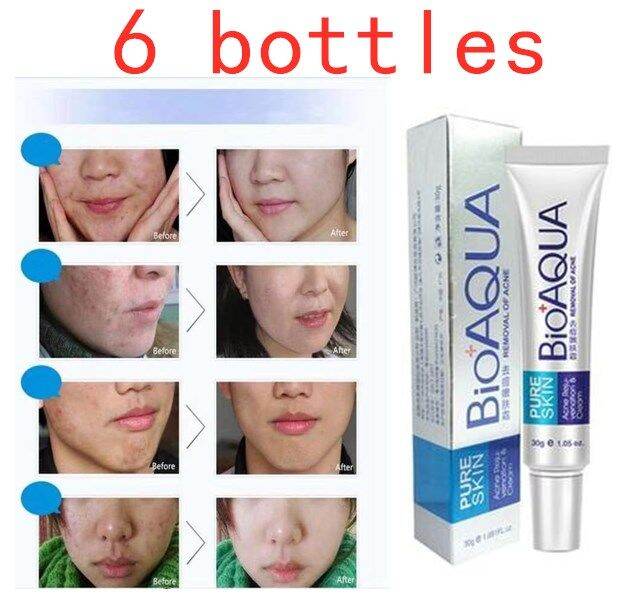 6 Bottles BIOAQUA Pure Skin Anti Acne CREAM 30g Lazada PH