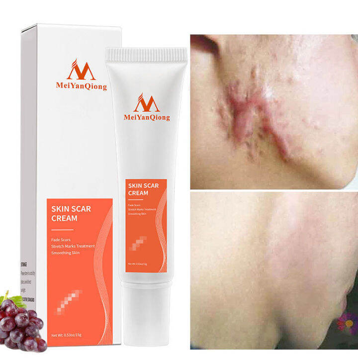 Scar Removal Cream Acne Scars Stretch Marks Surgical Scar Burn Repair