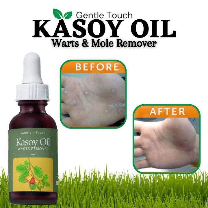 Gentle Touch Pure Organic Authentic Herbal Kasoy Oil 15ml Warts