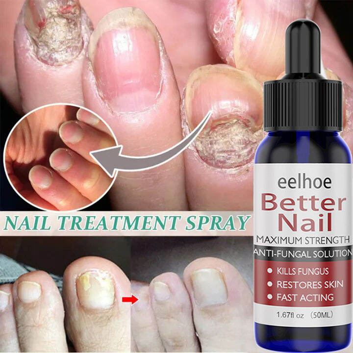 Eelhoe Nail Repair Treatment Creameffective In Daysnail Fungus