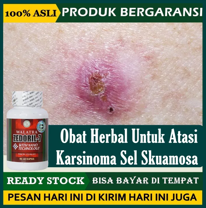 Obat Karsinoma Sel Skuamosa Obat Herbal Karsinoma Sel Skuamosa Obat