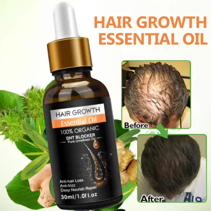 Hair Growth Essential Oil Biotin Cold-Pressed DHT Blocker and Hair Growth  Shampoo Anti-Hair Loss Conditioner | Lazada Singapore