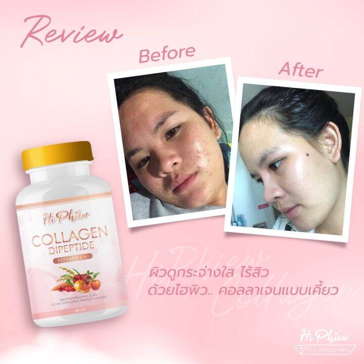 hi-phiew-collagen-ไฮพิวคอลลาเจน-คอลลาเจนแบบเคี้ยว-คอลลาเจนลดสิว-ผิวใส-ช่วยบำรุงกระดูกและข้อ-1กระปุก-มี-30-เม็ด