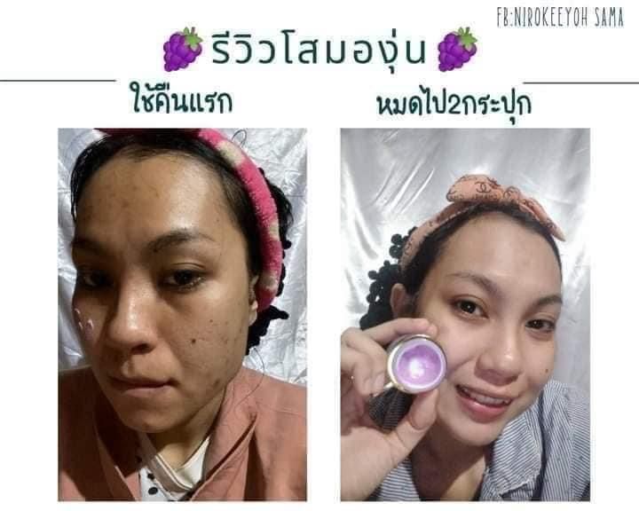 สาวกองุ่นมาจ้า-หน้าใส-ไร้สิว-ต้องโสมองุ่นค้าบ-น้องตะปุกจิ๋ว-แต่น้องประโยชน์เยอะน๊าา-ตะปุกม่วง-ครีมบำรุง-ลดปัญหาการเกิดสิว-หน้ากระจ่างใสมากยิ่งขึ้น-ลดรอยดำรอยแดง-รอยสิวจางลงเห็นได้ชัด-ครีมองุ่น-โสมองุ่