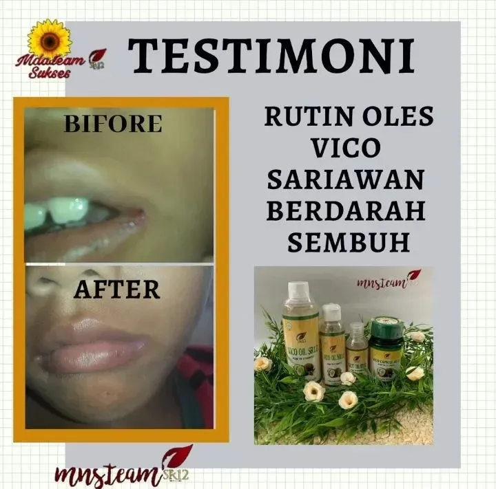 OBAT SARIAWAN AMPUH BPOM OBAT SARIAWAN MULUT DEWASA OBAT SARIAWAN ANAK