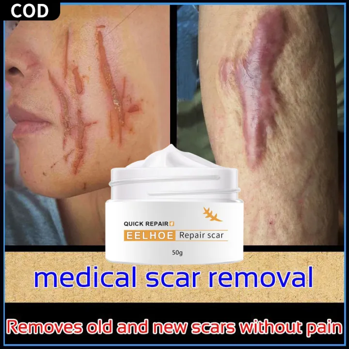 Picture of EELHOE Quick Repair Old Scar Remover for Legs Acne Remover Surgical ...