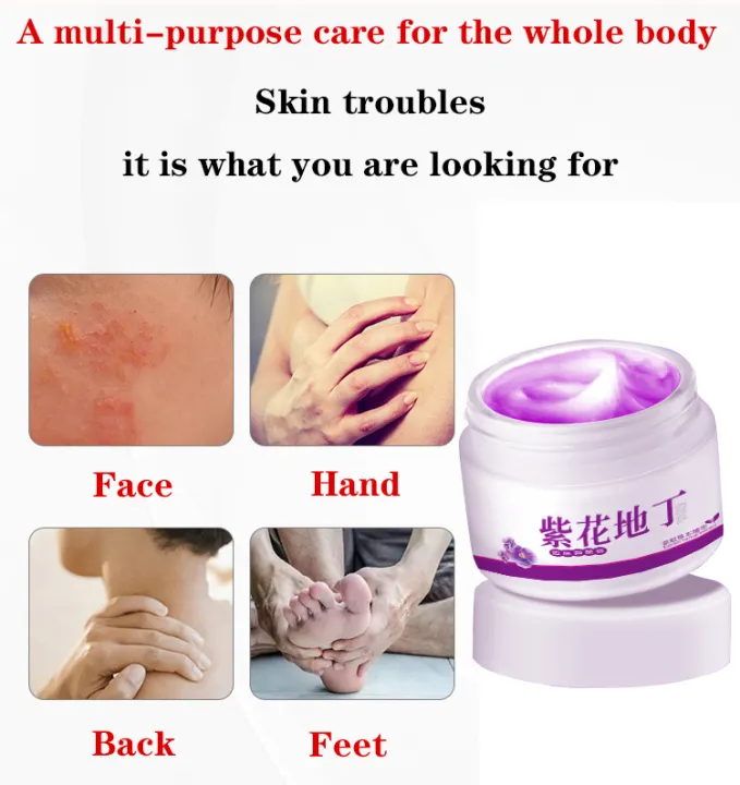 Psoriasis cream 30g Topical skin antibacterial cream Quick antipruritic