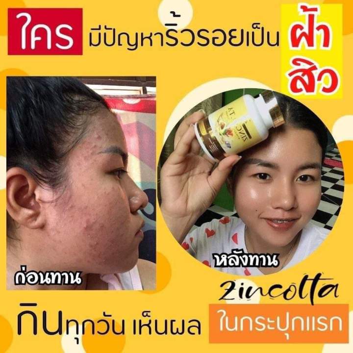 ซินคลอต้า-zincolta-น้ำมันอะโวคาโด้สกัดเย็นผสมคอลลาเจนเข้มข้น-แก้ปัญหาผิวได้ดีสุดจากภายในสู่ภายนอก-ของแท้ส่งฟรี