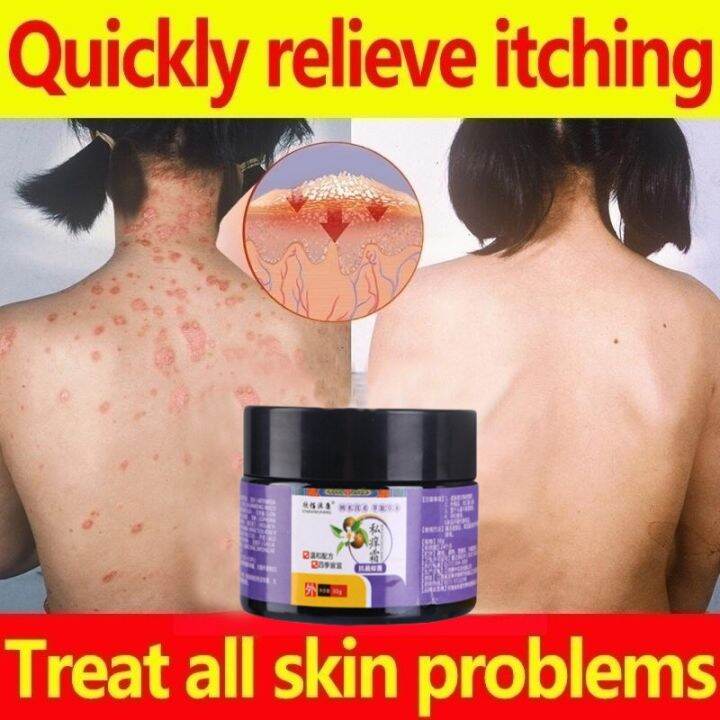 ubat kurap gatal gatal kulit私处止痒杀菌 Inner thigh itching Psoriasis Cream