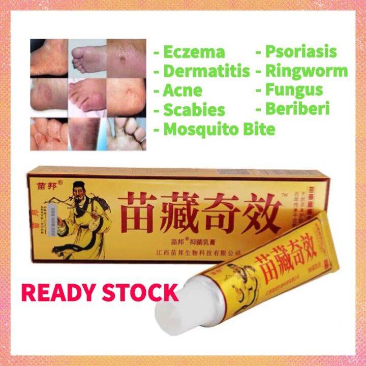 Eczema Psoriasis Beriberi Fungus 100 Chinese Herbal Cream Ubat Gatal