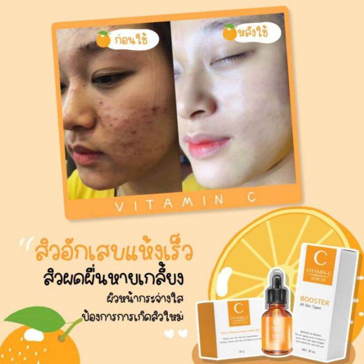 เซรั่มวิตซีส้ม-โปร1ขวด-แถมฟรีสบู่ส้ม1ก้อน-สินค้าพร้อมส่งของแท้เท่านั้น