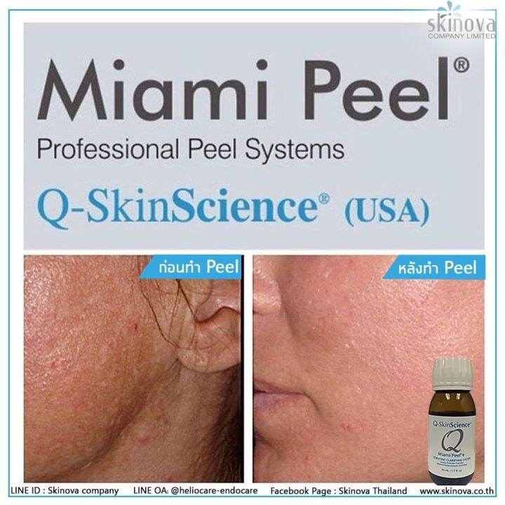 Miami peel ผลัดเซลล์ผิวหน้าใส ลดฝ้า กระ สิว 7.5 ml Lazada.co.th