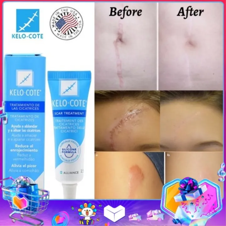 KElO·COTE Scar Removal Cream & Old Scar Remover and whitening & Peklat