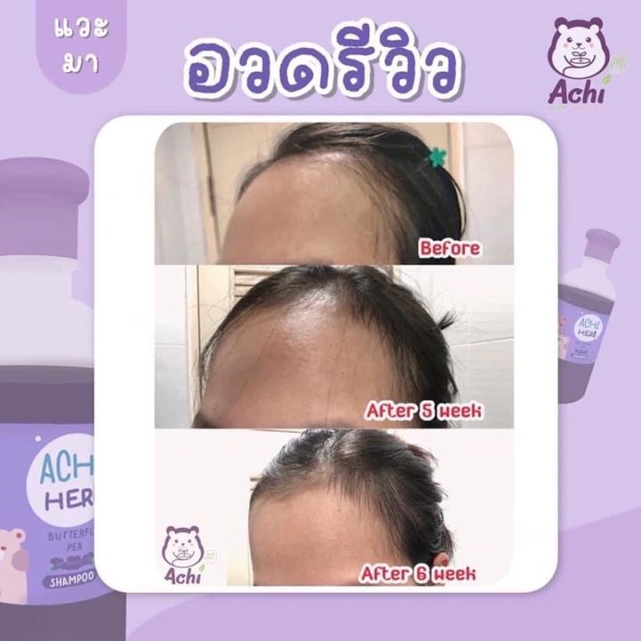 แชมพูเด็กเร่งผมยาวไว-สมุนไพรอัญชัน-ออแกนิค100-300ml-ใช้ได้ทุกเพศทุกวัย