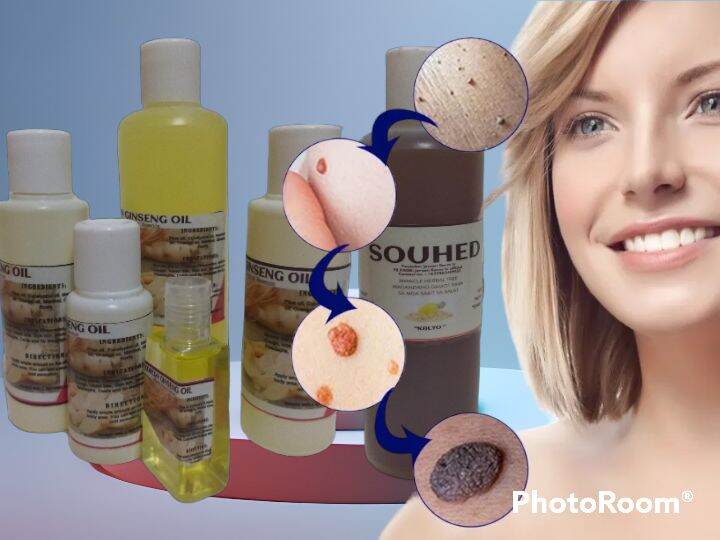 SOUHED 300ML | KULUGO REMOVAL KALYO REMOVAL | Lazada PH