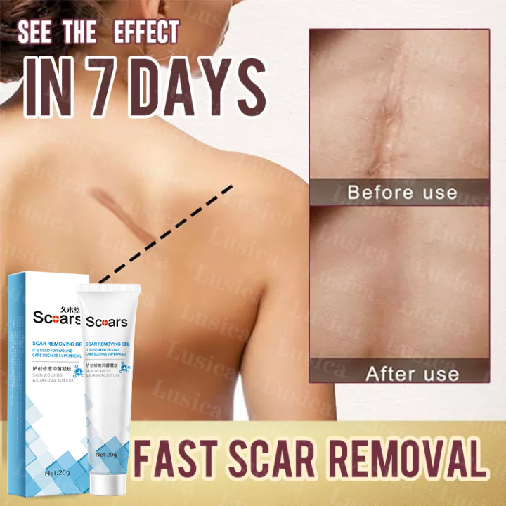 Scar Remover for Old Scar on Leg Scar Gel Original Stretch Mark Remover