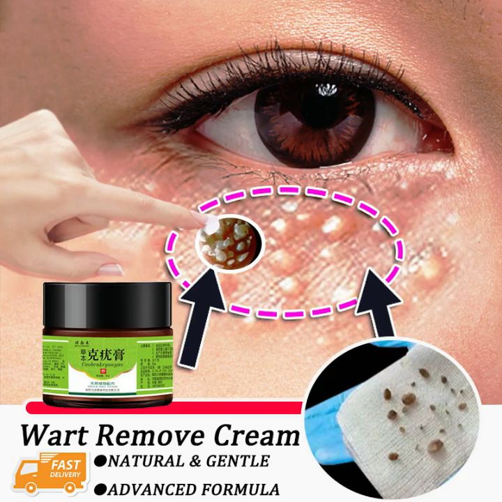 Warts cream Eye cream Warts & Moles Remover cream 20g Warts ...