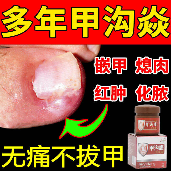 Paronychia Anti-Inflammatory Anti-Swelling Treatment Special Medicine ...