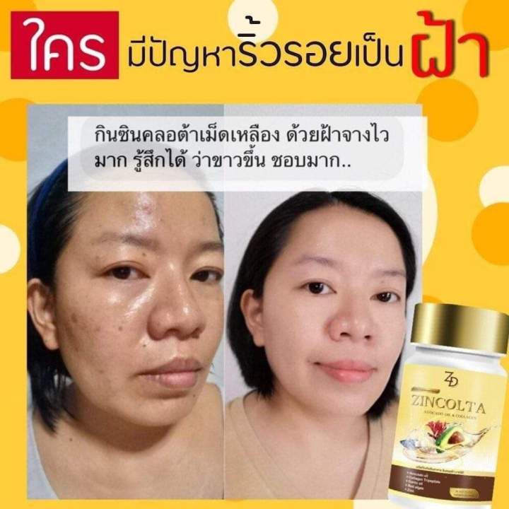 ซินคลอต้า-zincolta-น้ำมันอะโวคาโด้สกัดเย็นผสมคอลลาเจนเข้มข้น-แก้ปัญหาผิวได้ดีสุดจากภายในสู่ภายนอก-ของแท้ส่งฟรี