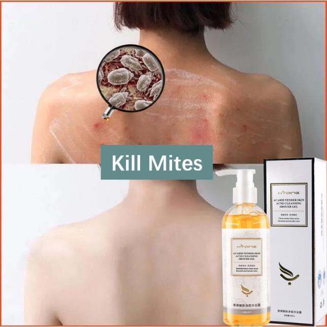Antiacne Shower Gel Remove mites Body Wash Body Acne Care Clean Back