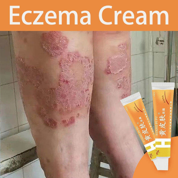 Eczema Cream Psoriasis Cream Antifungal Cream Itching antibacterial
