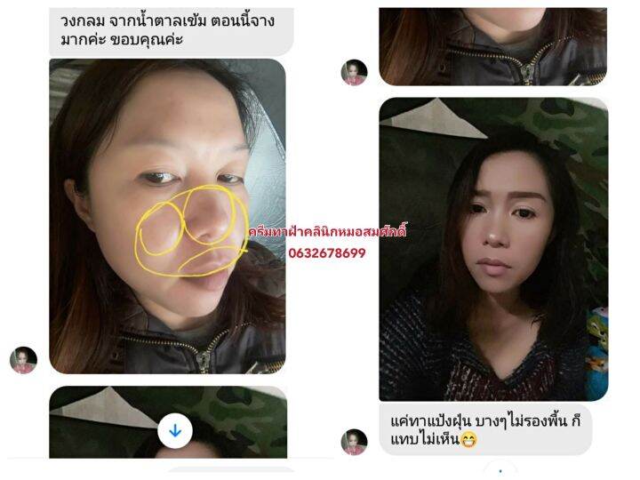 ส่งฟรี-คู่ครีมรักษาฝ้า-หน้าเด็ก-คลินิกหมอสมศักดิ์-นายแพทย์สมศักดิ์-คุณจักร