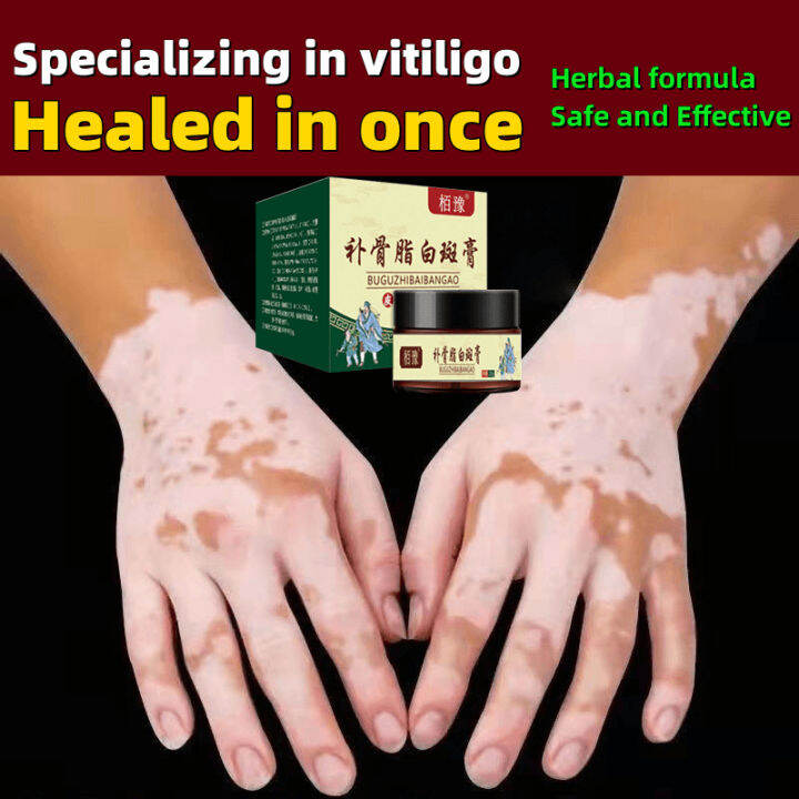Vitiligo cream remove white spot Vitiligo treatment cream 20g Suitable