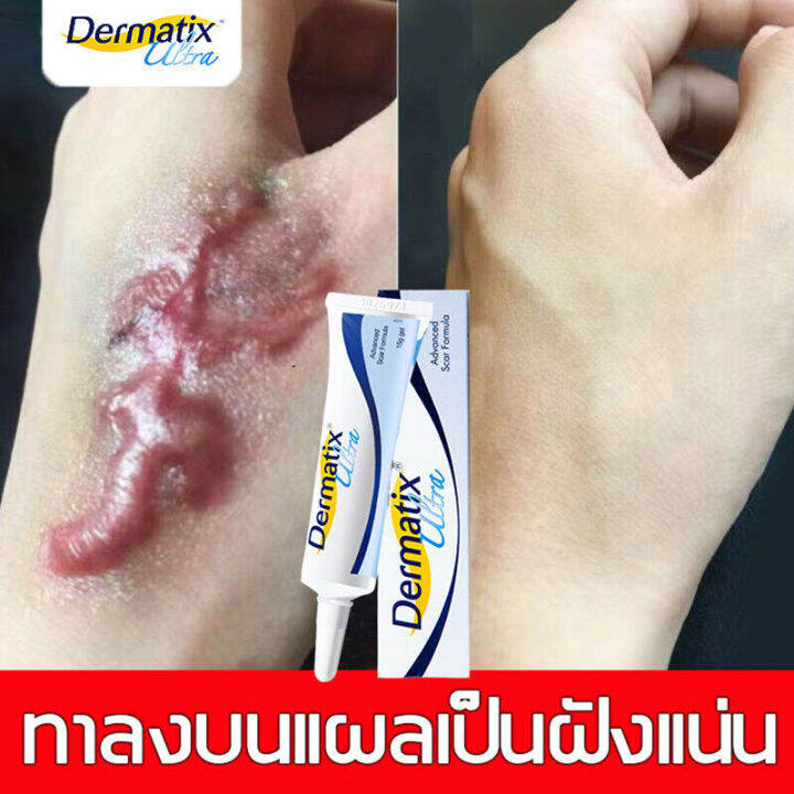 ยาทาแผลเป็น เห็นผล กำจัดรอยแตกลาย แผลไฟไหม้ น้ำร้อนลวก ซ่อมแซมผิวที่เสียหาย  บำรุงผิวให้แข็งแรง ยาลบรอยแผลเป็น ครีมลบแผลเป็น ครีมทาแผลเป็น ครีมลดแผลเป็น  ครีมลบรอยแผลเป็น ลบรอยเเผลเป็น ครีมลดรอยแผลเป็น ครีมลบรอยแผลดำ |  Lazada.Co.Th