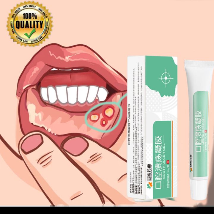 ORAL ULCERS OINTMENT ORAL PASTE Aphthous mouth ulcer gel effective ...